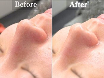 ボーンオム(Born Homme)/毛穴洗浄+美容液導入:20代女性