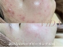 ヴィーダ 渋谷松濤(ViDA)/お肌を育てるハーブピーリング