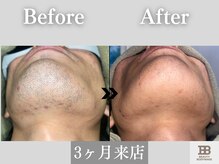 ビューティーアンドボディメイクBB シャオ西尾店/見えないアゴの下もスッキリ