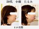 ランティル(l’until)の写真/ダイエットでも落ちない顔の脂肪。輪郭からはみ出る脂肪。二重アゴの脂肪を分解。たるみもスッキリ解決!
