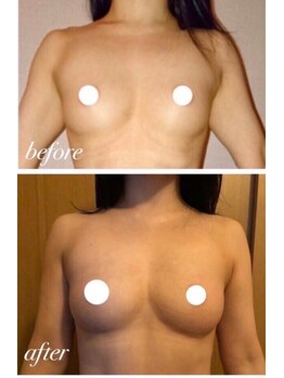 美人バスト 札幌店/バストアップ×育乳 &nbsp;◇症例◇