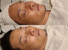 ブラン(BLANC)/シミケアフェイシャルPREMIUM