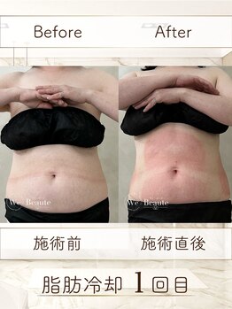 ウィボーテ(We Beaute)/【痩身】脂肪冷却×脂肪分解