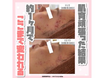 ホワイトアクア 岐阜店(WHITE AQUA)/ハーブピーリング/岐阜/ニキビ