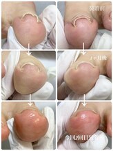 ペディラボ 荻窪店(Pedi Labo)/巻き爪ケア　症例（１）