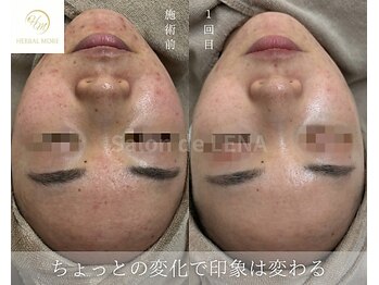 サロンドレナ 名駅店/ハーブピーリング サロンドレナ