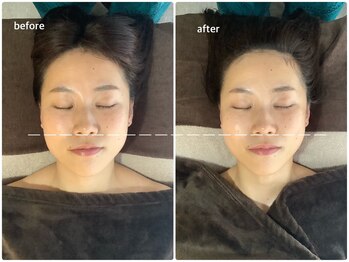 アベリア リュウ(Aberia Lieu)/頭蓋小顔矯正/小顔矯正