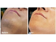 シフォン(Chiffon)/髭脱毛　before★after　1