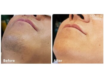 シフォン(Chiffon)/髭脱毛　before★after　1