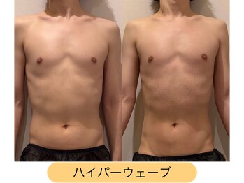 クレヴィア バイ サイバーエステ(CREBIA)/【お腹を引き締めたい方】