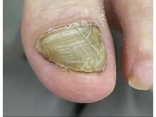 クリーム ネイル 西船橋(CREAM NAIL)の雰囲気（巻爪.魚の目.変形爪.自分で切れない等ご相談ください[西船橋]）
