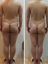 カロン(Kalon)/セル脂肪ケアで痩せやすい体に