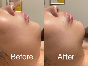 アフター(AFTER)/フェイスラインが気になる方