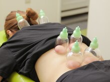 かんざき鍼灸接骨院/カッピング