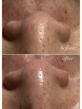 スパークル/毛穴/ワックス/脱毛/小顔