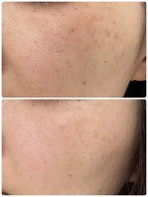 アンド ユー(and.yu)/40代/シミケア・美肌コース5回