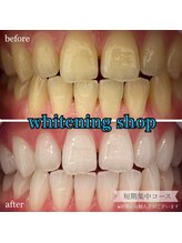 ホワイトニングショップ 桜木町店/【タバコのヤニ落ちます】