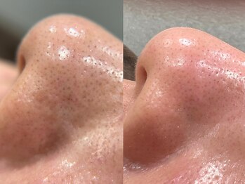 あすはれ/ハイドロヴィーナスの効果