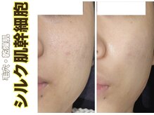 ブレア(Blair)/シルク肌幹細胞ピーリング