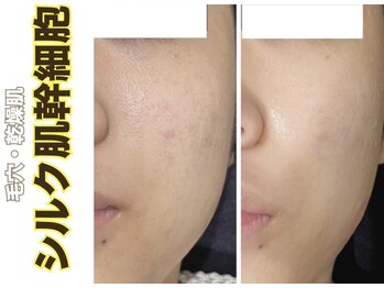 ブレア(Blair)/シルク肌幹細胞ピーリング