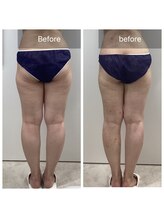 ダリア(Dahlia)/セルライトケア