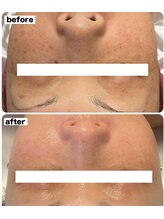 リリーココ(Lily Coco)/シミケア