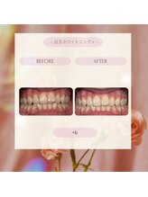 プラスビー 2号店(+b)/ホワイトニングビフォーアフター