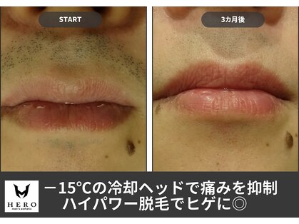 メンズ エステティック ヒーロー(men's esthetic HERO)の写真
