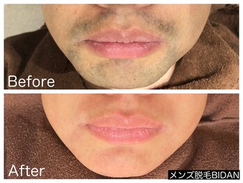 ビダン(BIDAN)/ヒゲ脱毛 BeforeAfter