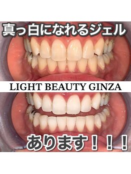 ライトビューティー 銀座店(LightBeauty)/東銀座　ホワイトニング症例写真
