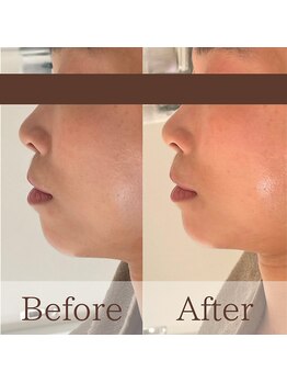 凪眠/小顔リンパフェイシャルの効果70