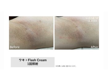 サロン ルアナ(salon luana)/ワキ脱毛　before→after
