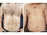 【メンズお腹脱毛】胸、お腹の毛に悩んでいる方必見！¥16,000→¥11000