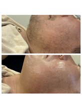 エピリア(Epilear)/メンズヒゲWax