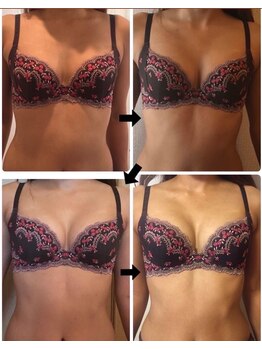 美人バスト 札幌店/バストアップ×育乳 &nbsp;◇症例◇