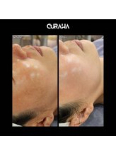 モアナ(Moana)/韓国肌管理┃ヒアルロン酸導入