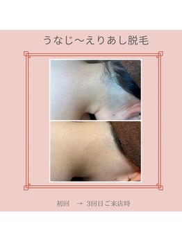 ノノ(nono)/うなじ～えりあし脱毛♪