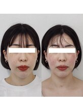 ヴェルシック(Belchic)/直後からでも効果を実感