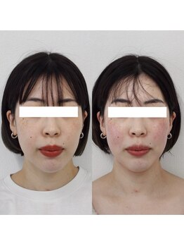 ヴェルシック(Belchic)/直後からでも効果を実感