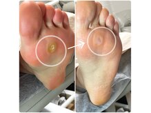 巻き爪フットケアサロン 神楽坂の雰囲気（タコ、魚の目、角質ケアで足裏がふわふわに♪）