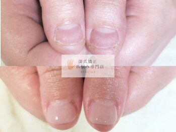 グラシナ なんば店/深爪/自爪育成/フィルイン