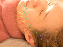 アロエベル(aloe Belle)/美容鍼