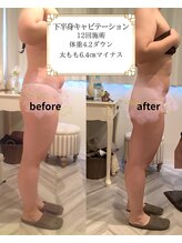 アマンジオ/オットー 新居浜店(amanjiwo/Otto)/キャビテーション・Before/After