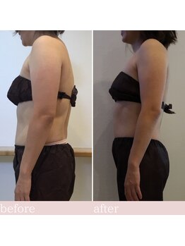 コハルチア(KohaLucia)/3回施術BeforeAfter