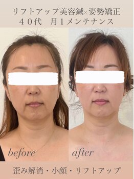 めい鍼灸院/リフトアップ美容鍼