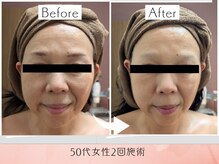 ラグーン(Lagoon)/WINBACK×小顔矯正コルギ