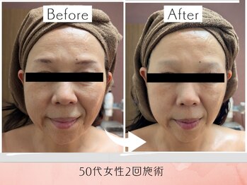 ラグーン(Lagoon)/WINBACK×小顔矯正コルギ