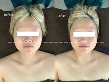 アベリア リュウ(Aberia Lieu)/頭蓋小顔矯正/小顔矯正