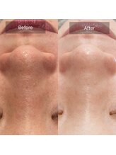 ミホノ 和泉中央店(mihono)/女性 毛穴洗浄