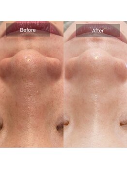 ミホノ 和泉中央店(mihono)/女性 毛穴洗浄